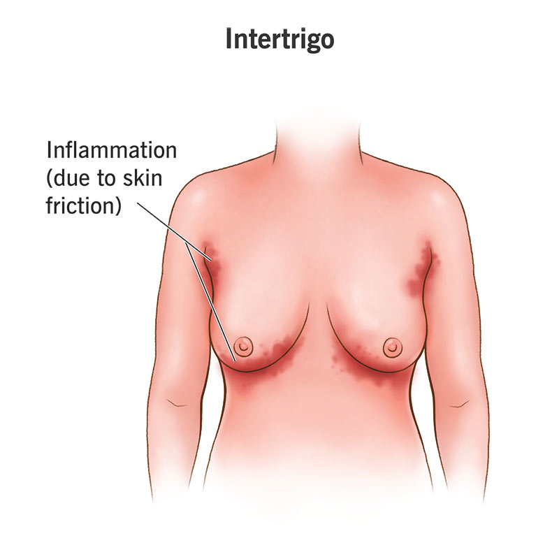 Sleaping_beauty-intertrigo-01