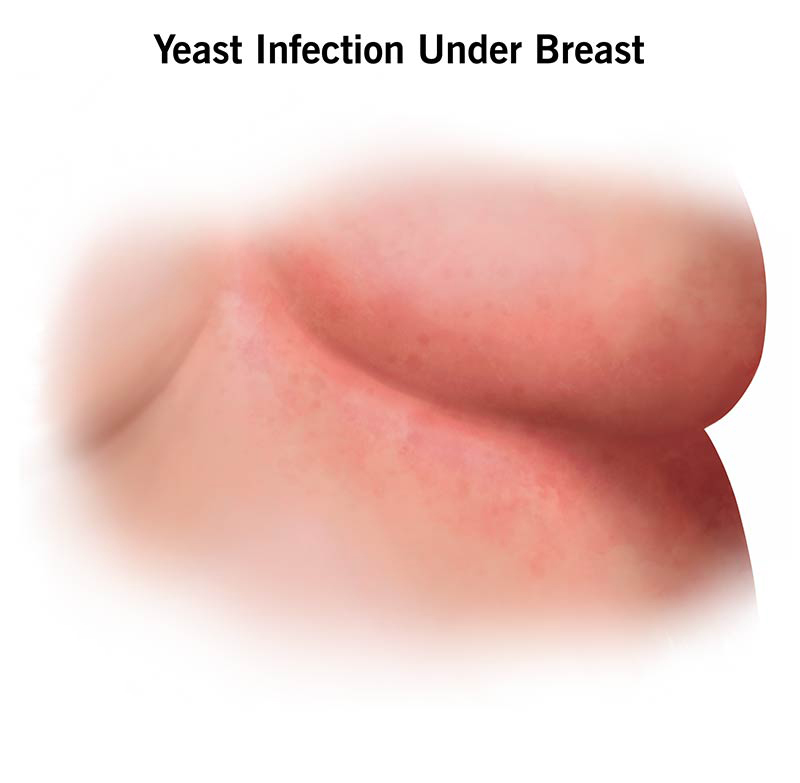 Sleeping-Beauty-yeast-infection-under-breast
