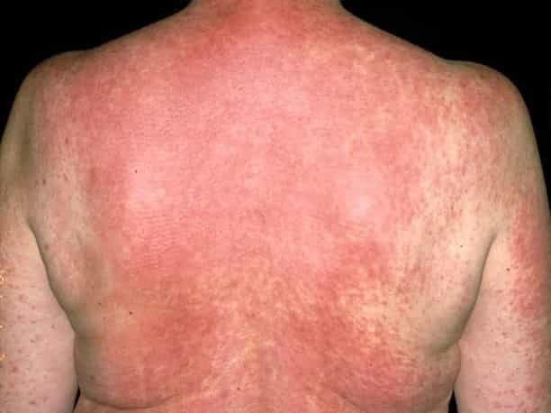sleeping-beauty-herb-10-common-skin-conditions
