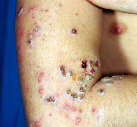 sleeping-beauty-herb-Atopic-Dermatitis-01