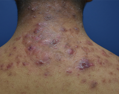 sleeping-beauty-herb-acne-type-iv