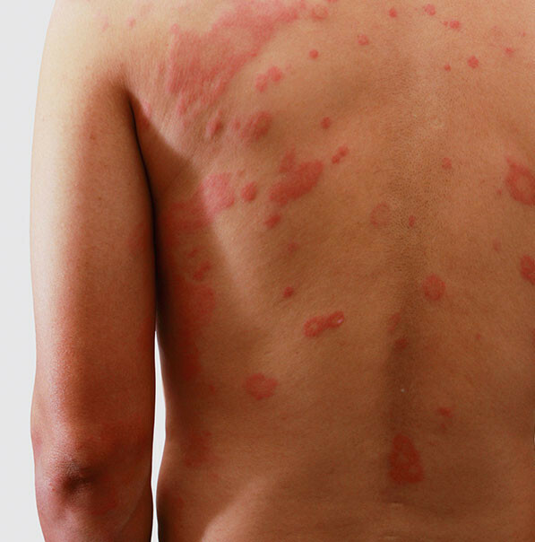 sleeping-beauty-herb-inline__back-skin-problems
